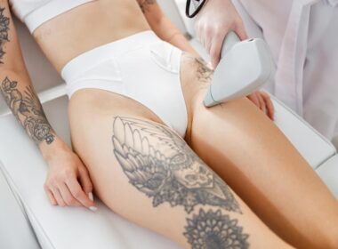 Czy po laserowym usuwaniu tatuażu pozostaje blizna? Co z nią zrobić?