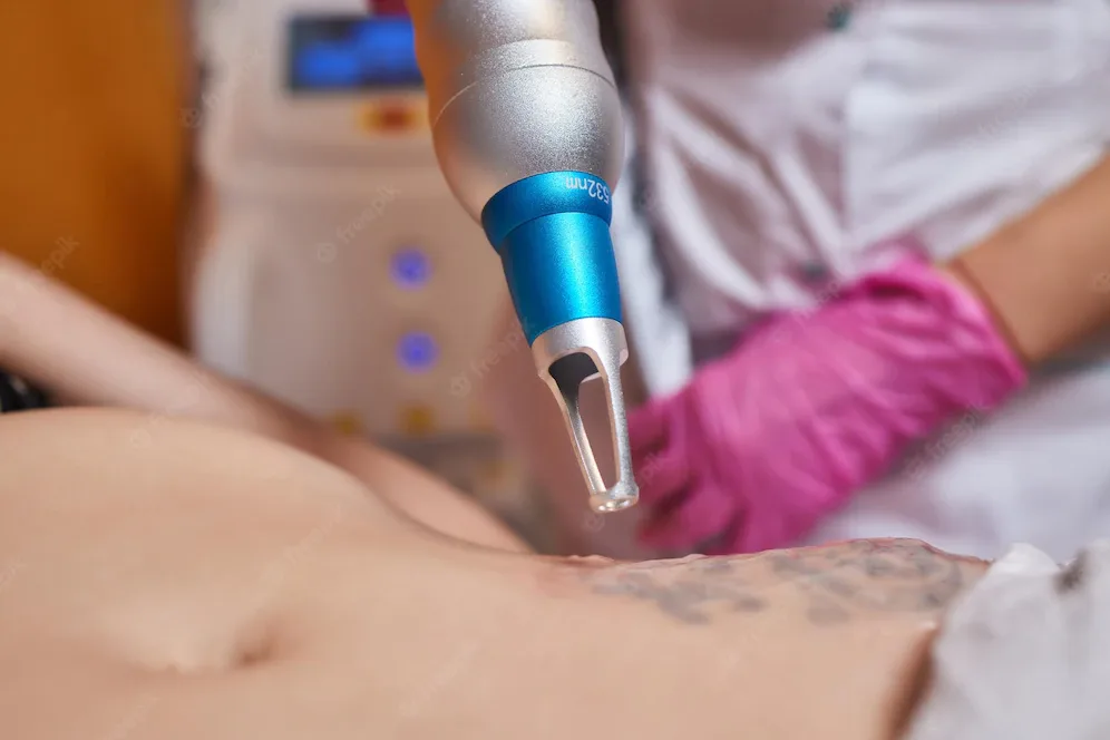 Jak przygotować się do laserowego usuwania tatuażu