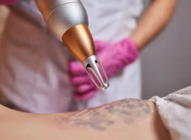 Czy każdy rodzaj tatuażu może być usunięty laserem?