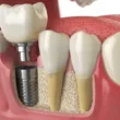 implanty zębowe kraków